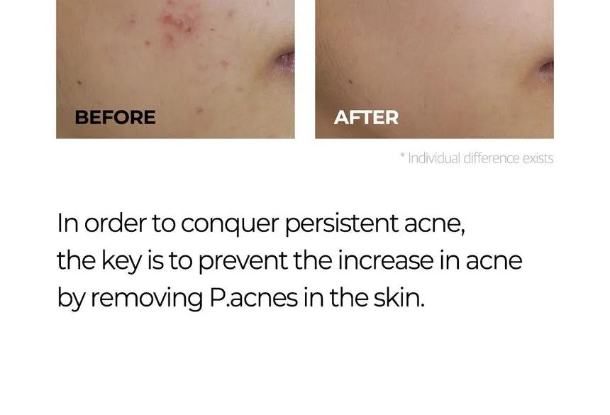 SOME BY MI Miracle AC Clear Spot Treatment 10ml